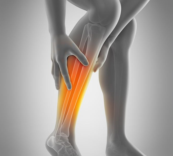 Shin Splints